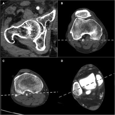 Intraindividual variance of lower limb rotation in patients with bilateral knee osteoarthritis